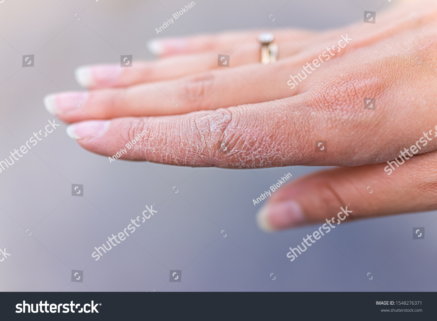 stock-photo-dry-cracked-skin-macro-closeup-of-index-finger-of-female-young-woman-s-hand-showing-eczema-medical-1548276371